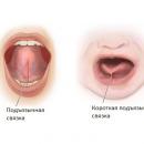 Подрезать ли уздечку языка?